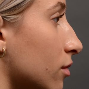 415 rhinoplasty, dr oakley smith, toronto, top surgeon, nose job