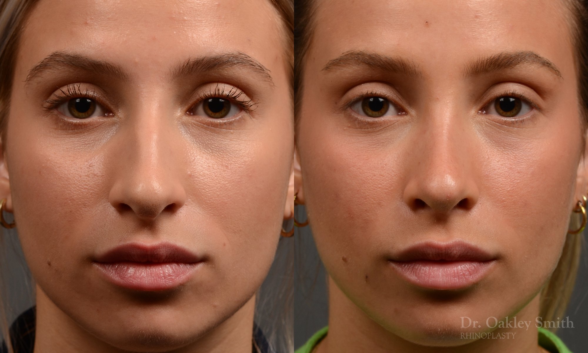 415 rhinoplasty, dr oakley smith, toronto, top surgeon, nose job