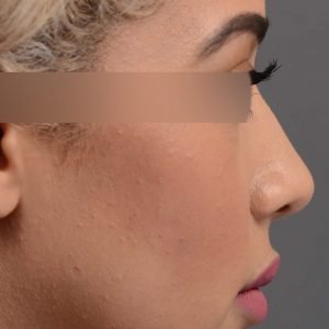 416 rhinoplasty, dr oakley smith, toronto, top surgeon, nose job