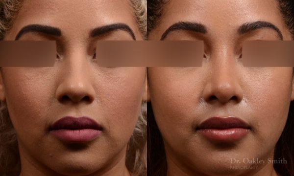 416 rhinoplasty, dr oakley smith, toronto, top surgeon, nose job