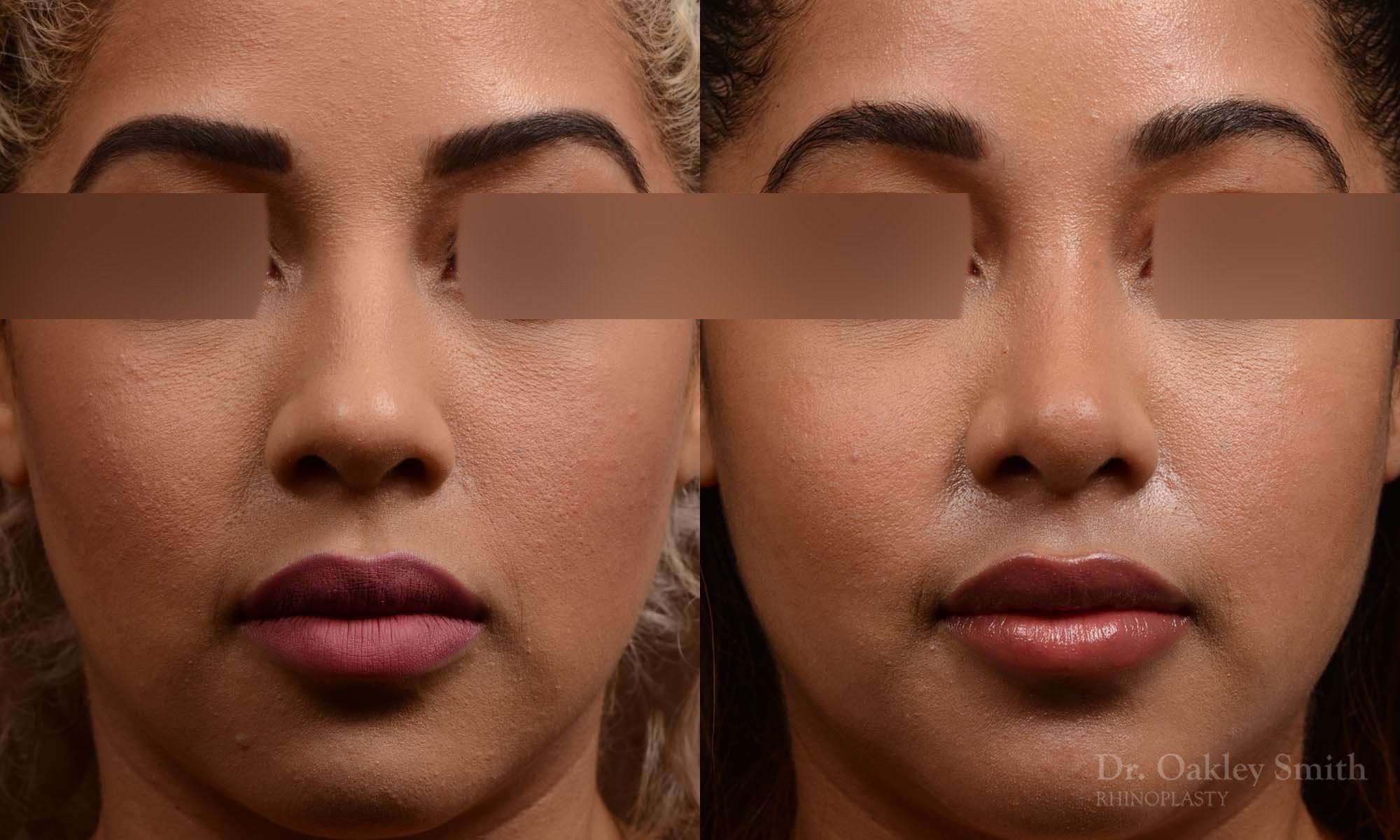 416 rhinoplasty, dr oakley smith, toronto, top surgeon, nose job