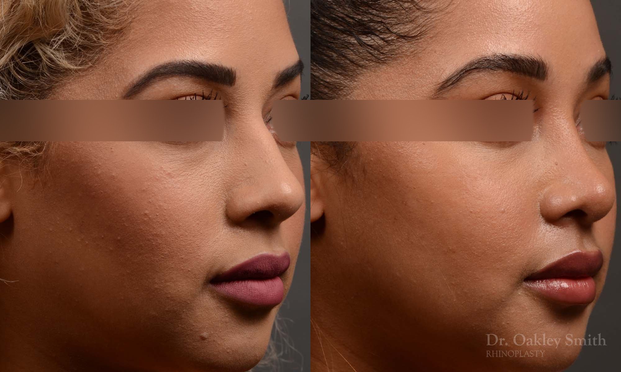 416 rhinoplasty, dr oakley smith, toronto, top surgeon, nose job