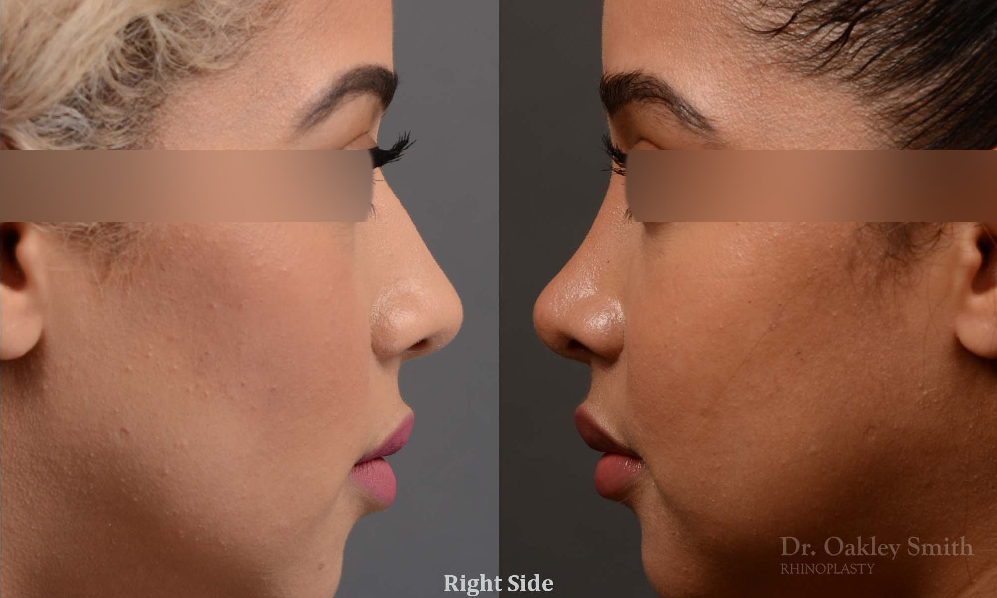 416 rhinoplasty, dr oakley smith, toronto, top surgeon, nose job