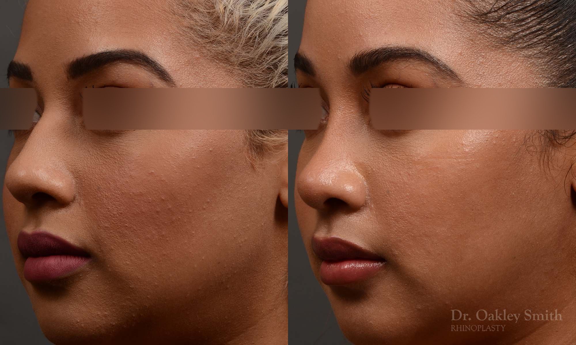 416 rhinoplasty, dr oakley smith, toronto, top surgeon, nose job