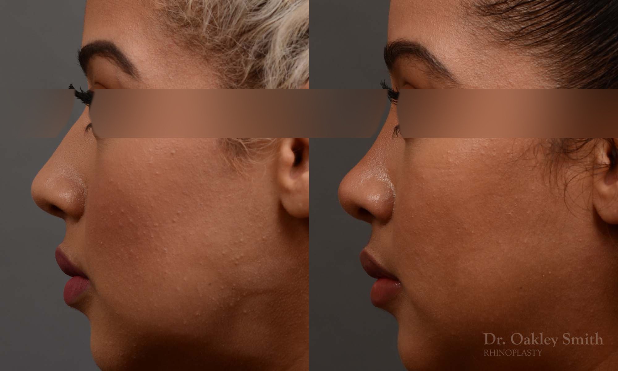 416 rhinoplasty, dr oakley smith, toronto, top surgeon, nose job