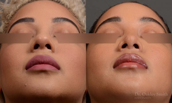416 rhinoplasty, dr oakley smith, toronto, top surgeon, nose job