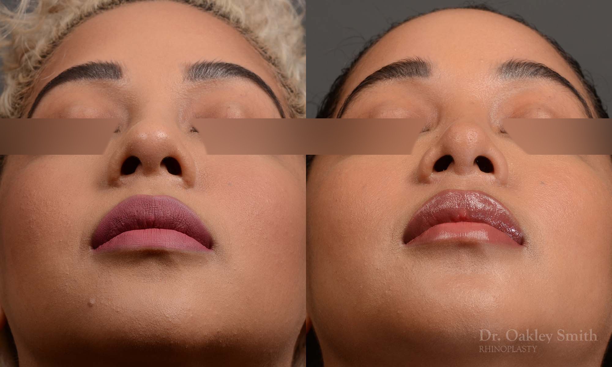 416 rhinoplasty, dr oakley smith, toronto, top surgeon, nose job