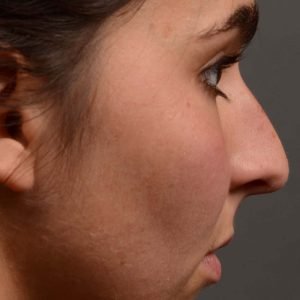 417 rhinoplasty, dr oakley smith, toronto, top surgeon, nose job