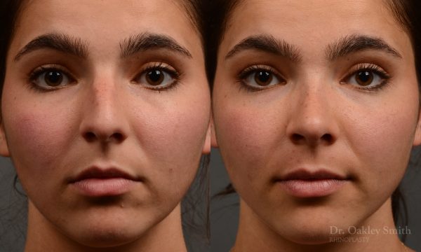 417 rhinoplasty, dr oakley smith, toronto, top surgeon, nose job