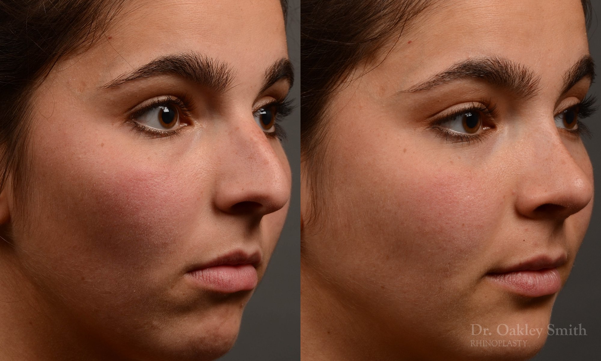 417 rhinoplasty, dr oakley smith, toronto, top surgeon, nose job