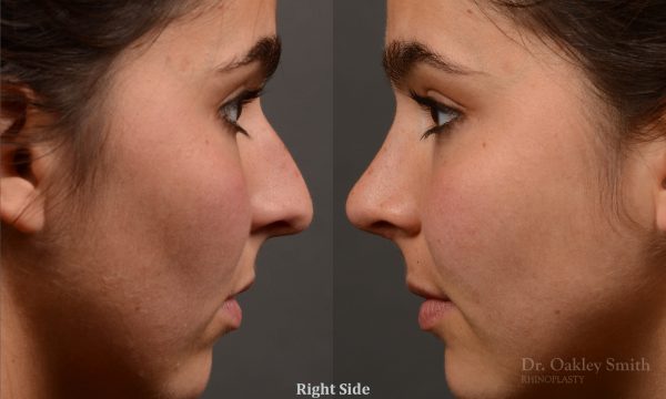 417 rhinoplasty, dr oakley smith, toronto, top surgeon, nose job