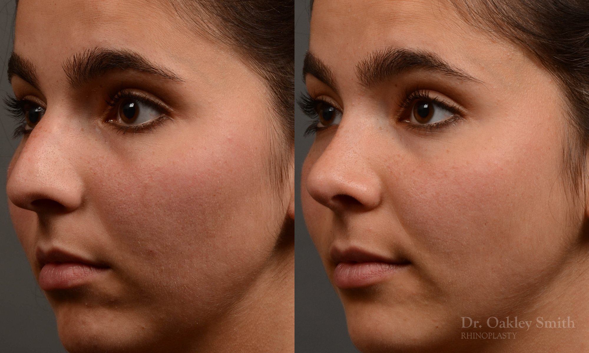 417 rhinoplasty, dr oakley smith, toronto, top surgeon, nose job