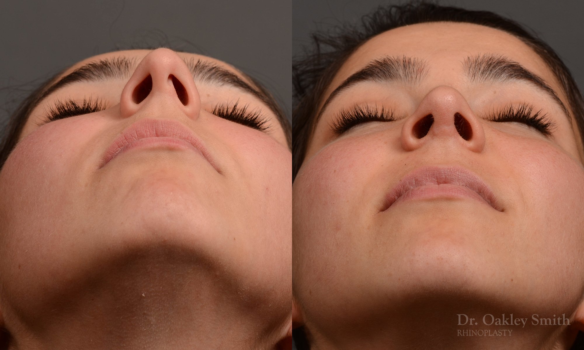 417 rhinoplasty, dr oakley smith, toronto, top surgeon, nose job