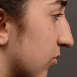 418 rhinoplasty, dr oakley smith, toronto, top surgeon, nose job