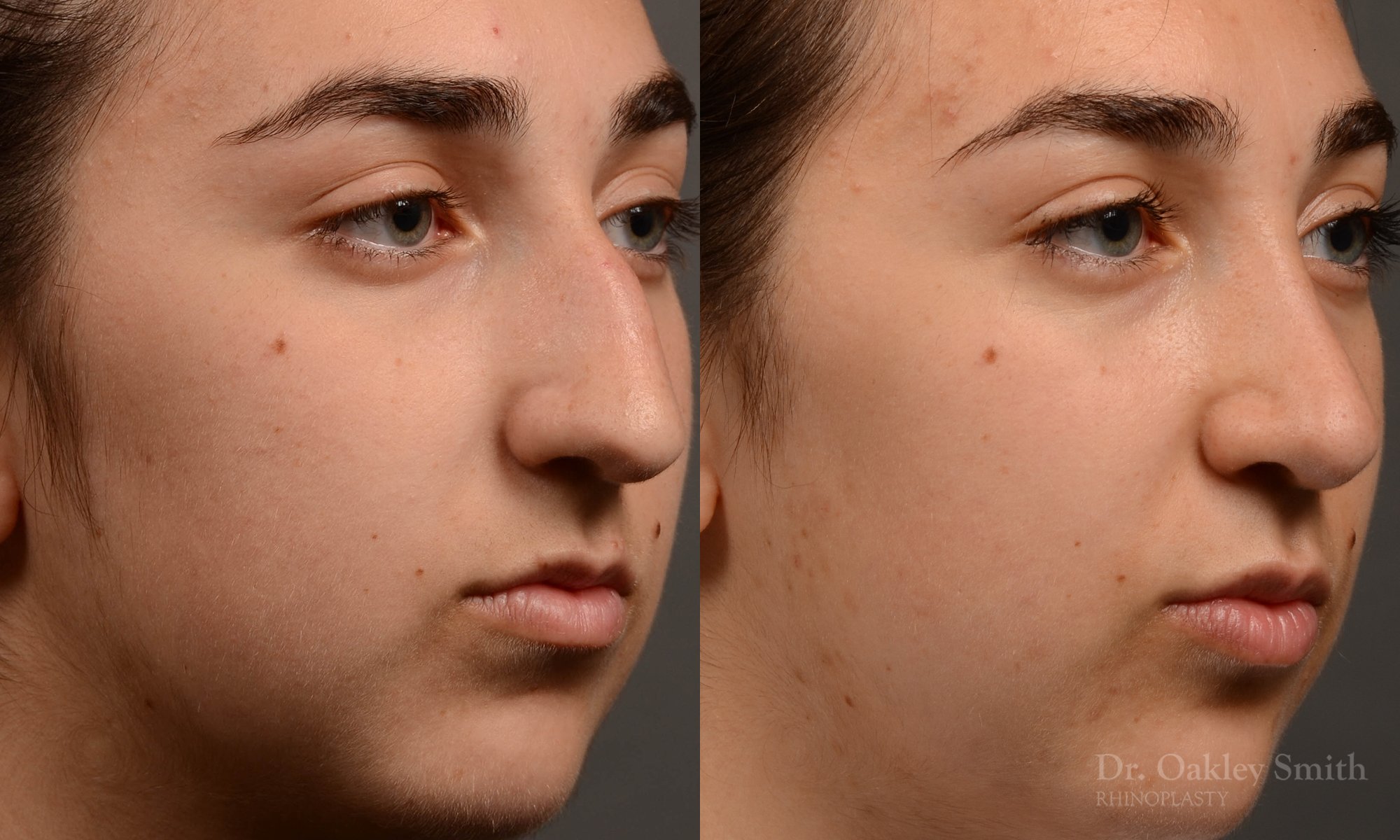 418 rhinoplasty, dr oakley smith, toronto, top surgeon, nose job