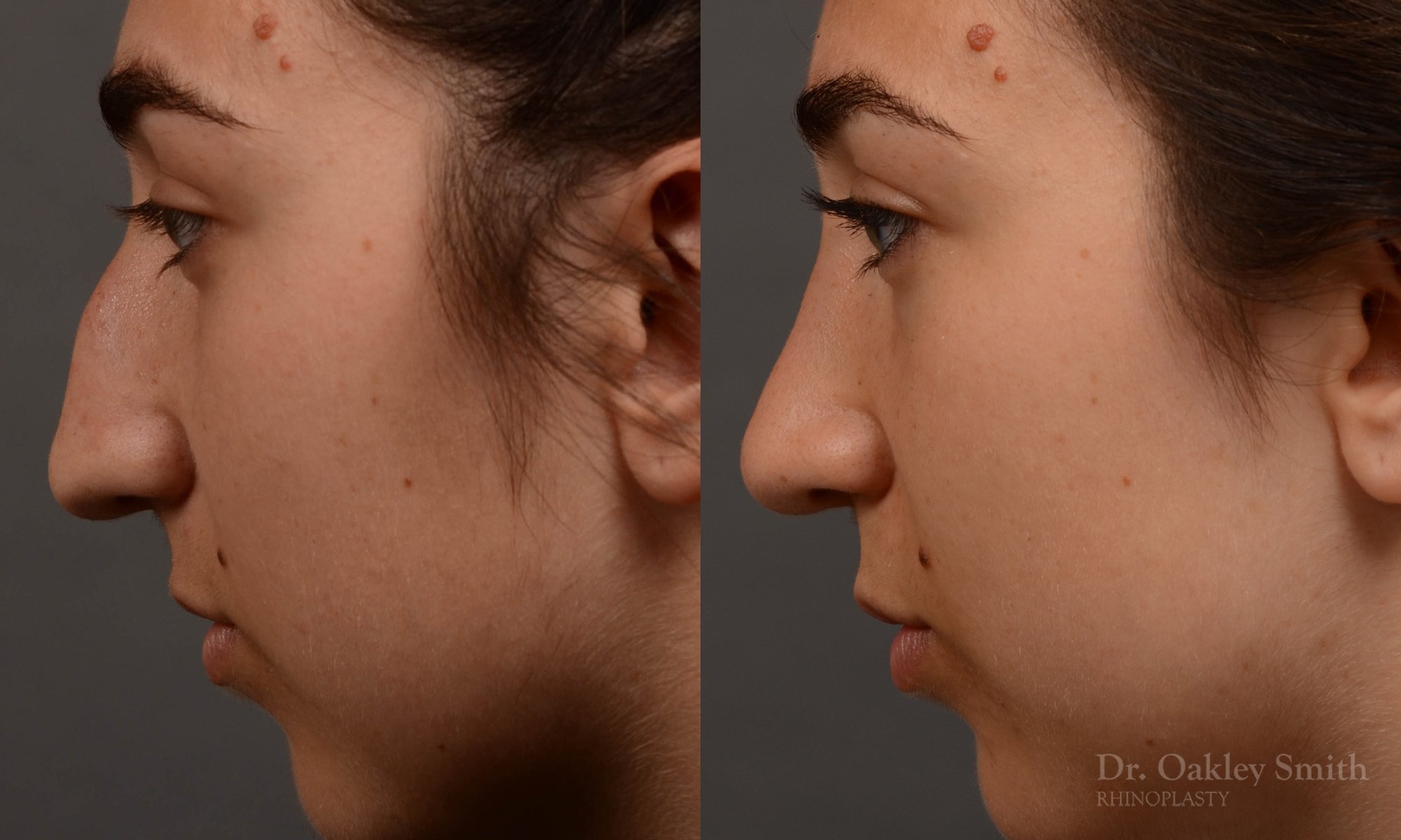 418 rhinoplasty, dr oakley smith, toronto, top surgeon, nose job