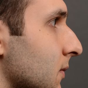 420 male rhinoplasty, dr oakley smith, toronto, top surgeon, nose job