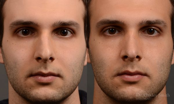 Frontal view rhinoplasty