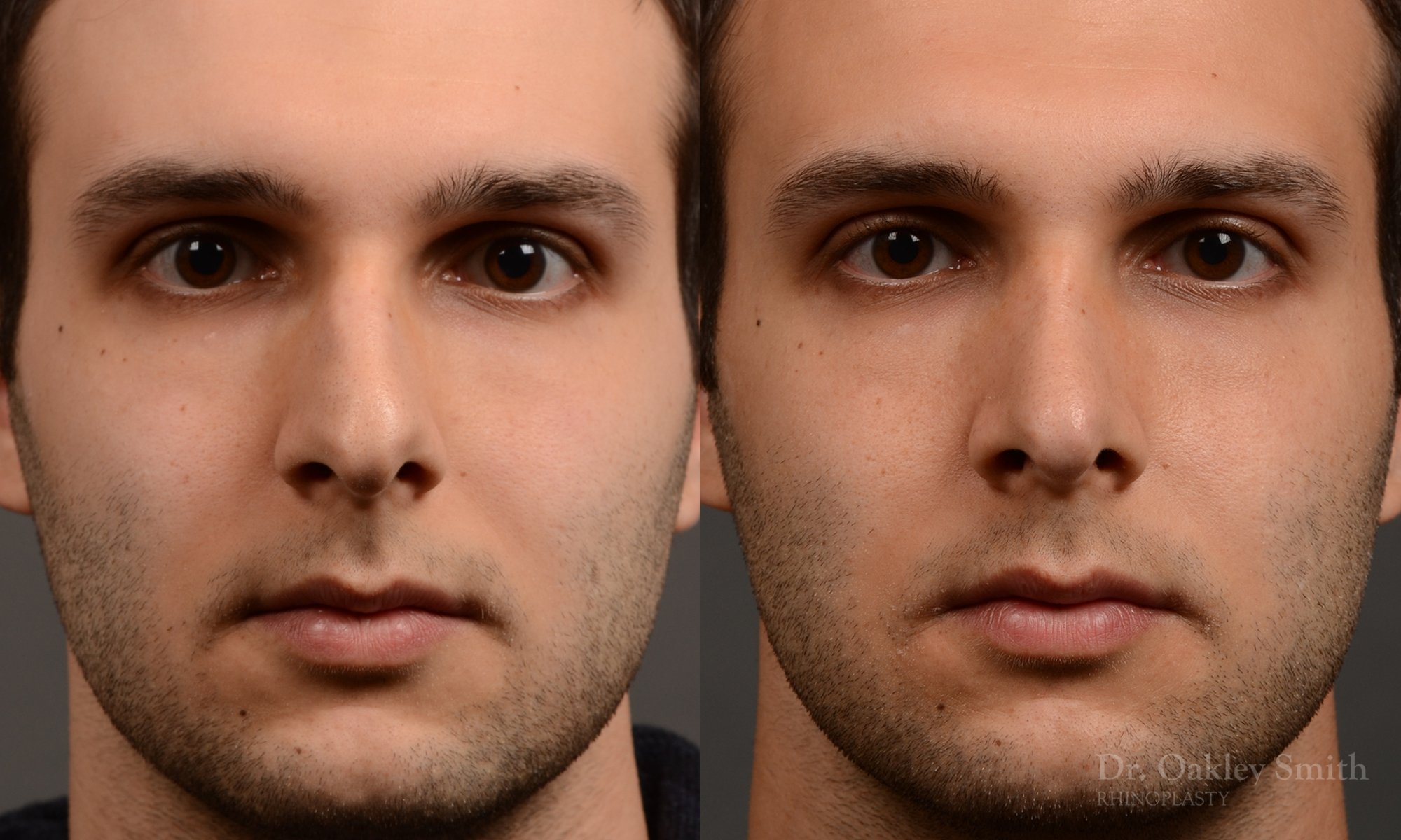 Frontal view rhinoplasty