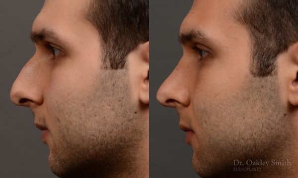 left profile side view