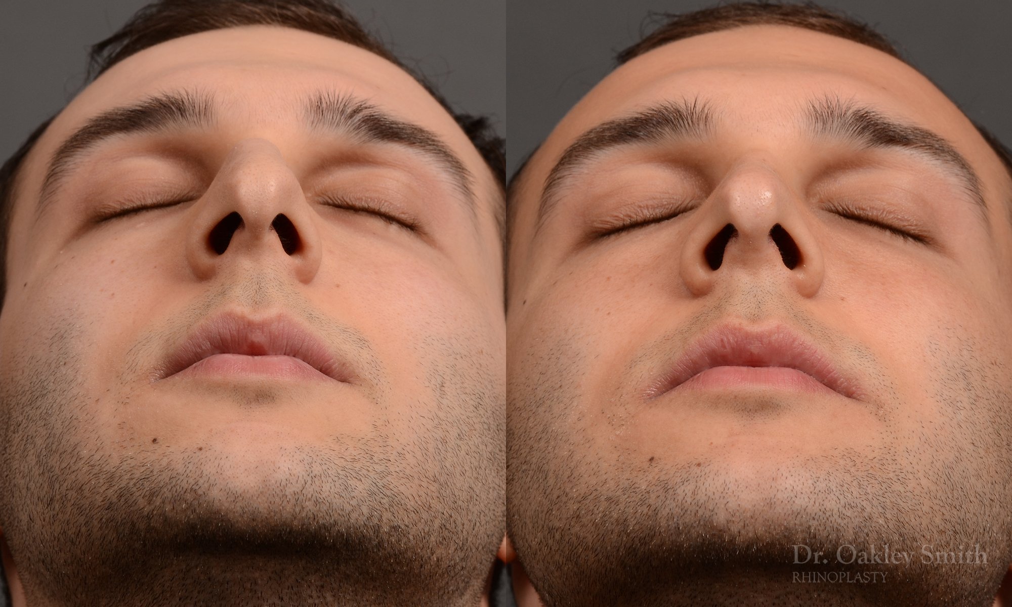 basal view of nose