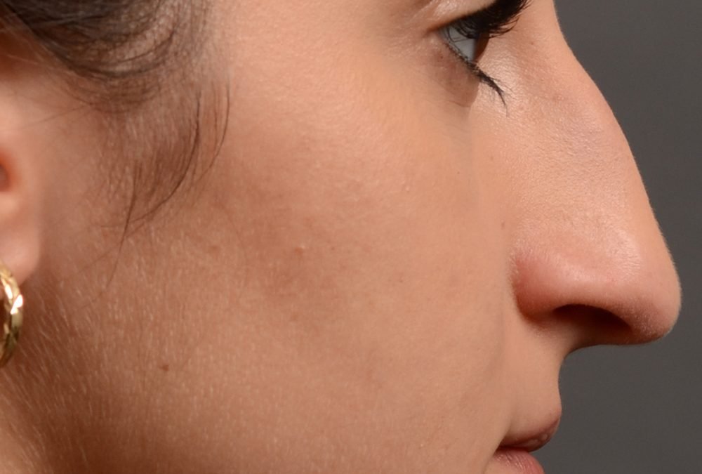 Rhinoplasty Before and After Case 422