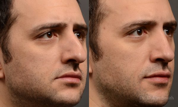 428A male rhinoplasty, dr oakley smith, toronto, top surgeon, nose job