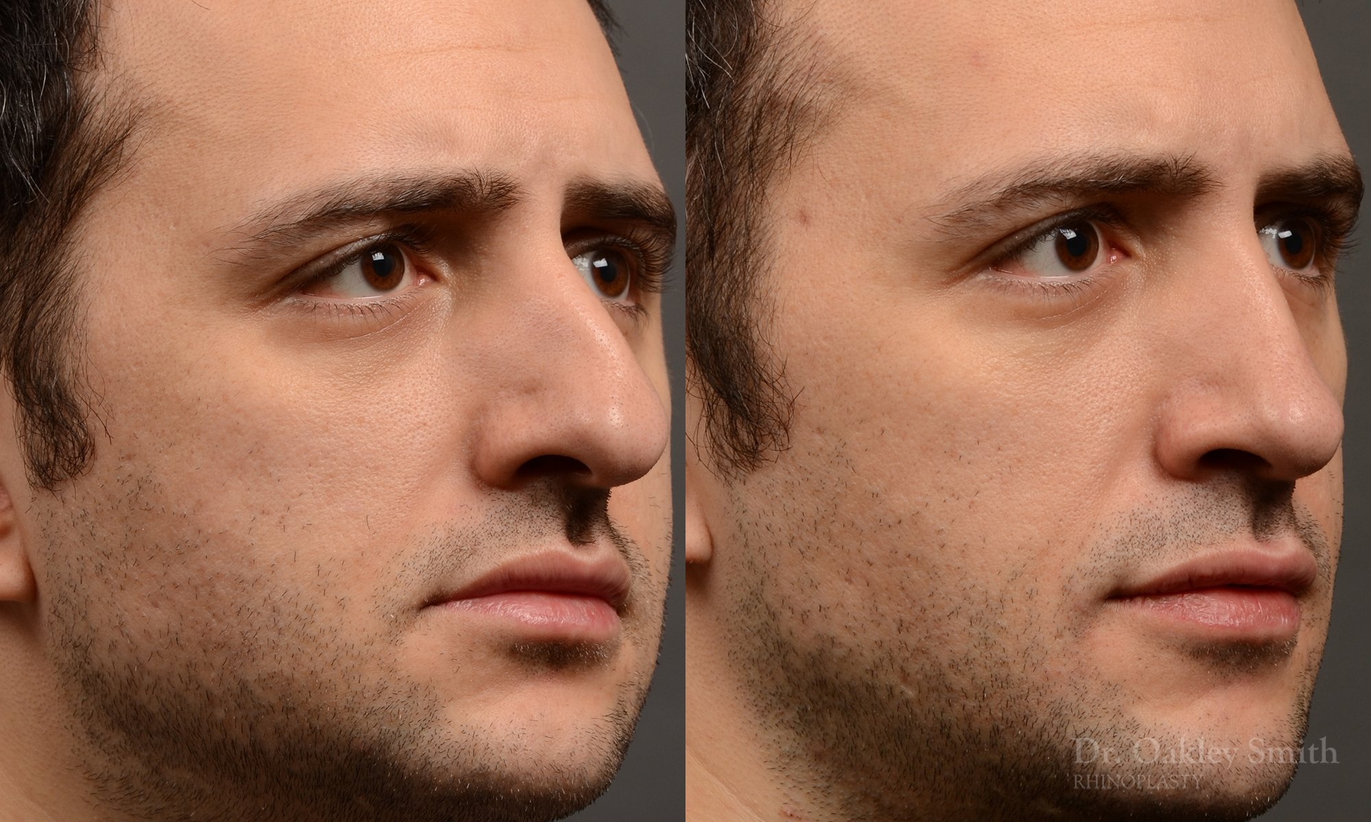 428A male rhinoplasty, dr oakley smith, toronto, top surgeon, nose job