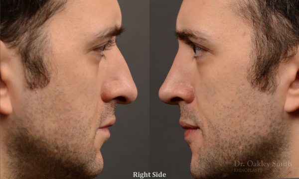 428A male rhinoplasty, dr oakley smith, toronto, top surgeon, nose job