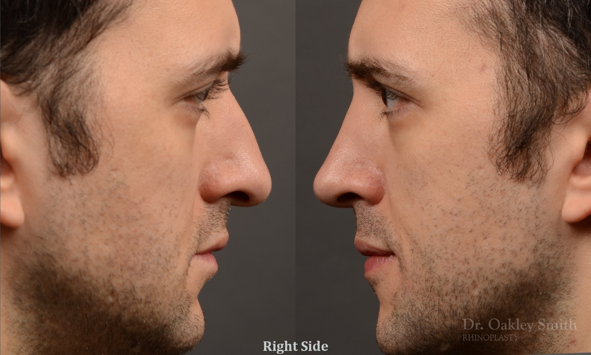 428A male rhinoplasty, dr oakley smith, toronto, top surgeon, nose job