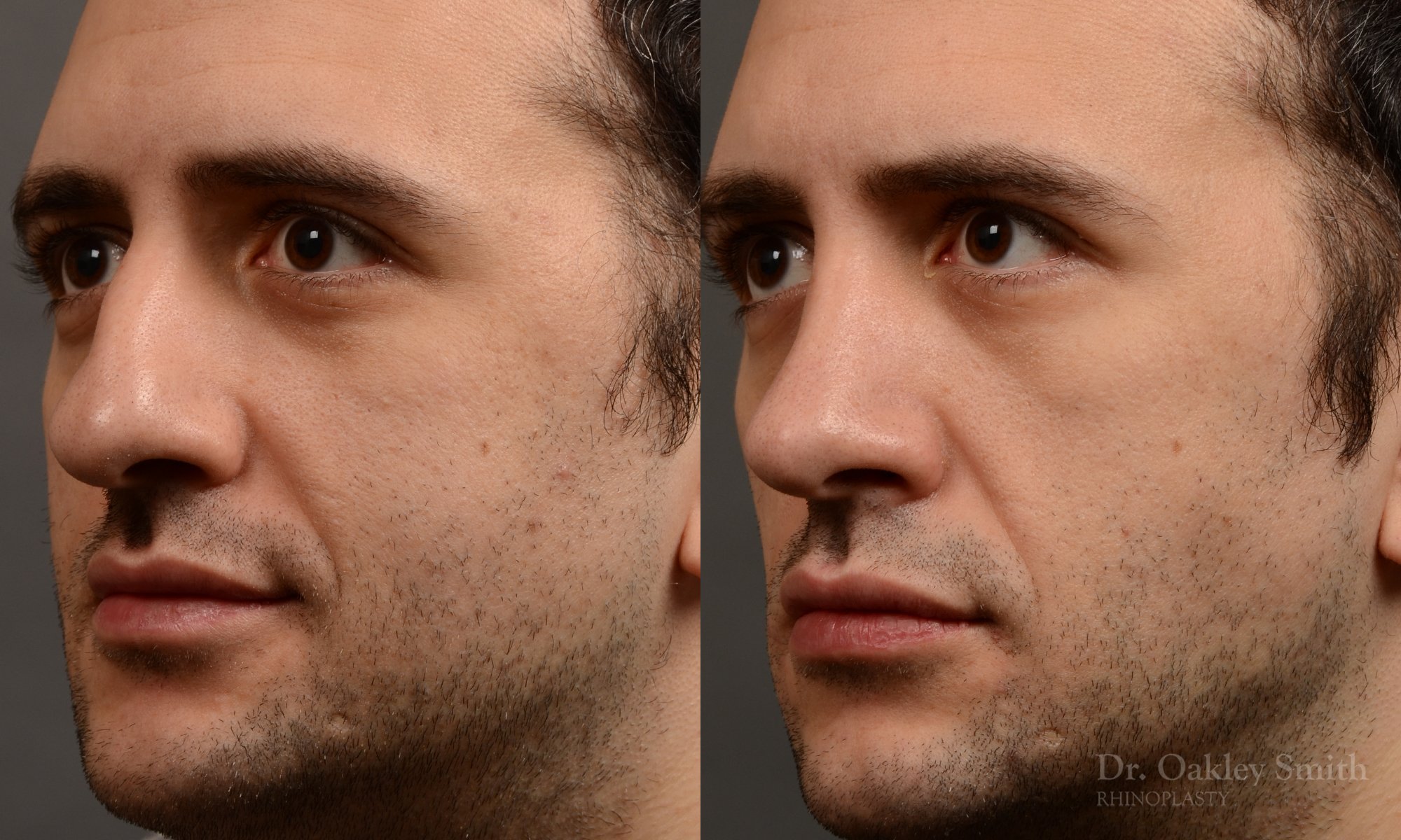 428A male rhinoplasty, dr oakley smith, toronto, top surgeon, nose job