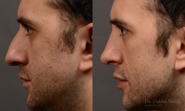 428A male rhinoplasty, dr oakley smith, toronto, top surgeon, nose job