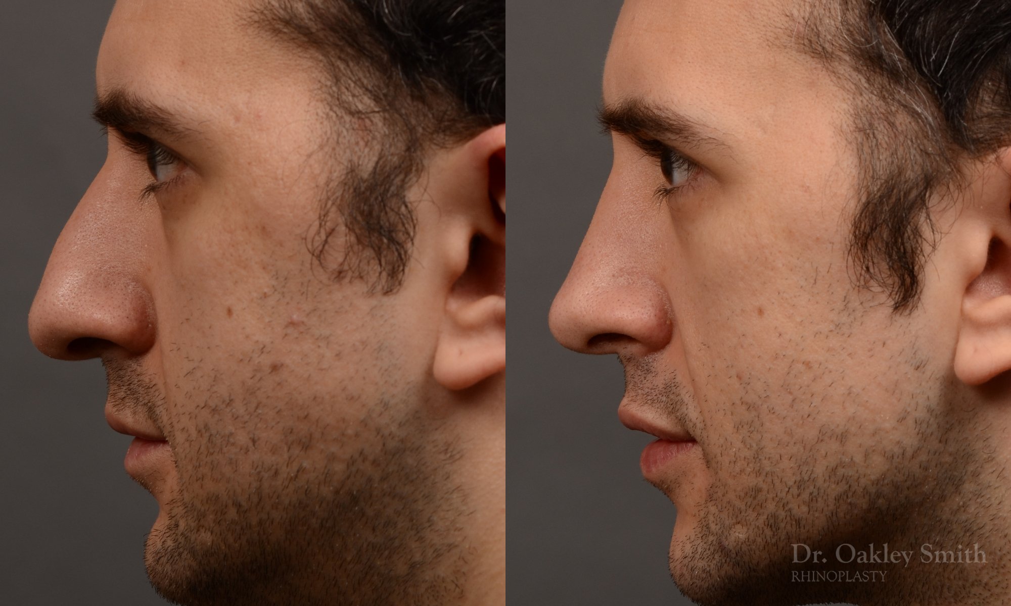 428A male rhinoplasty, dr oakley smith, toronto, top surgeon, nose job