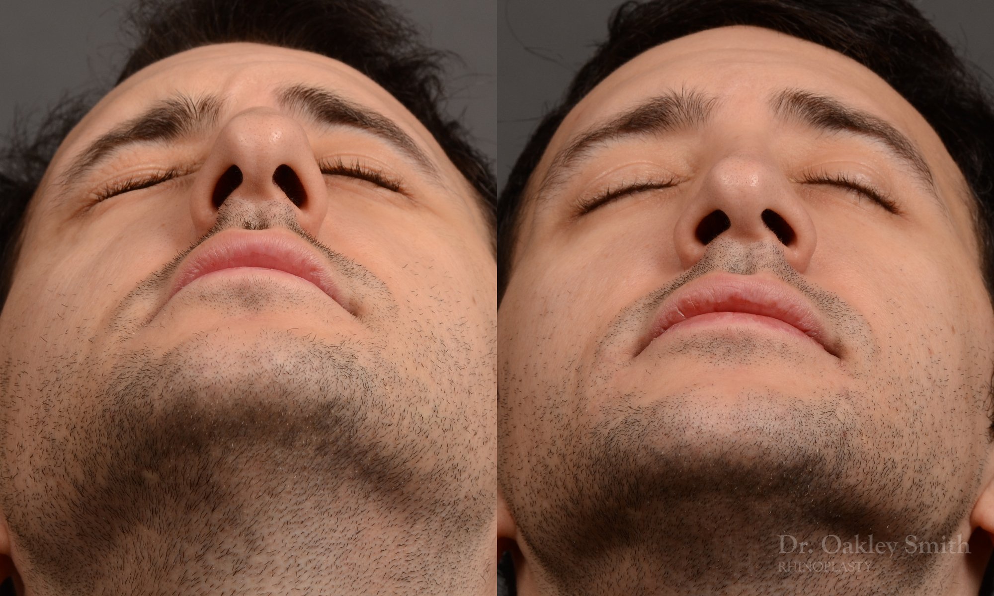 428A male rhinoplasty, dr oakley smith, toronto, top surgeon, nose job
