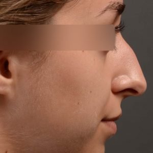 Dr. Oakley Smith accomplishes during his surgeries than a collection of before and after case studies. As one of a hand full of surgeons in North America who limits his practice to only Rhinoplasty surgery