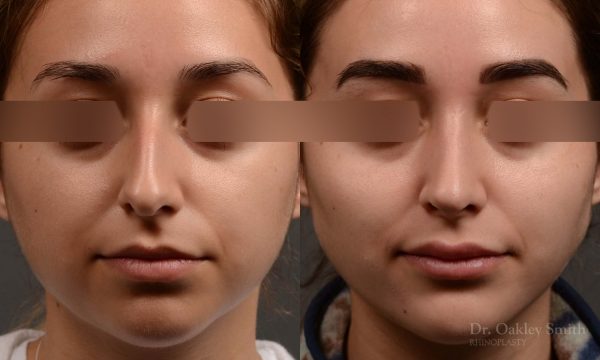 Dr. Oakley Smith accomplishes during his surgeries than a collection of before and after case studies. As one of a hand full of surgeons in North America who limits his practice to only Rhinoplasty surgery