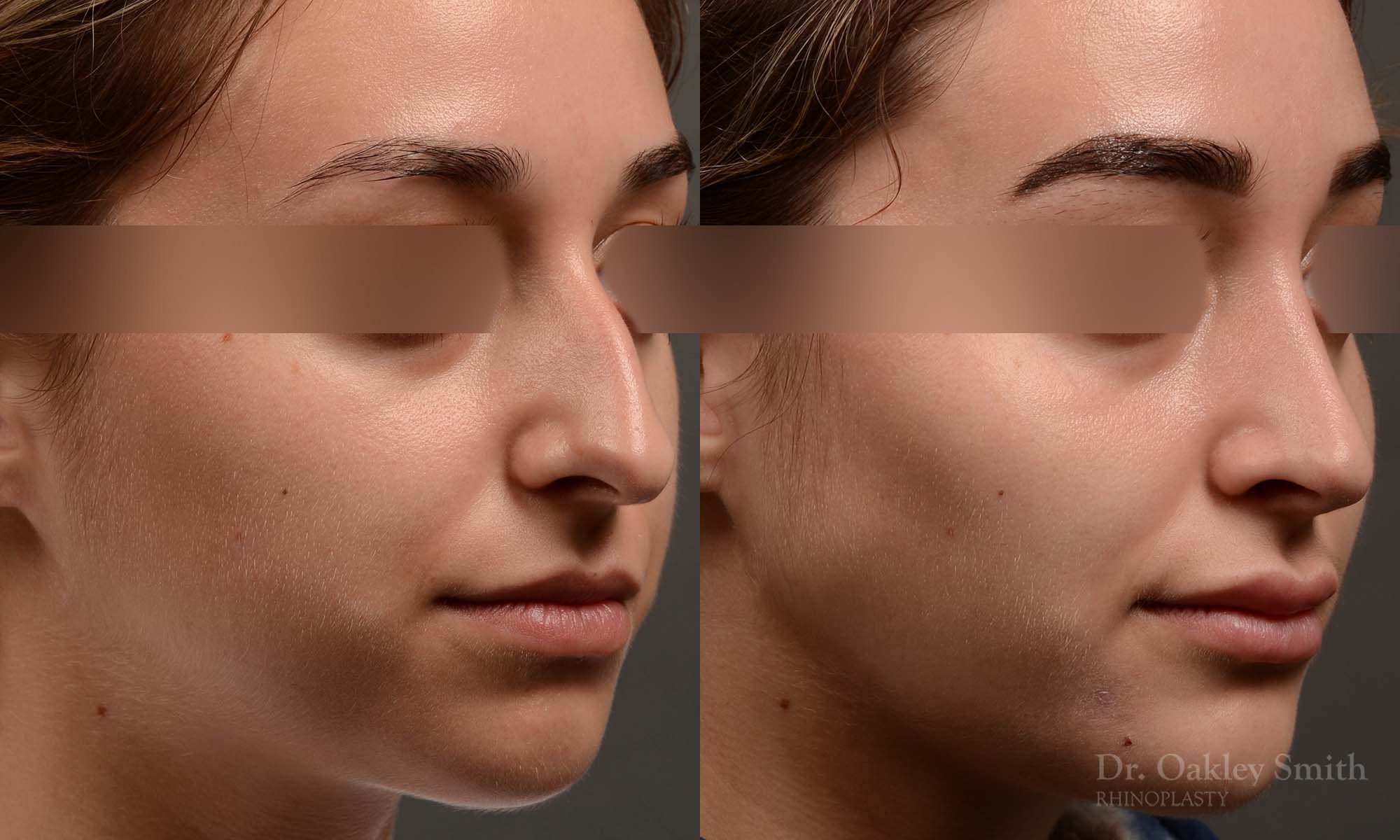 Dr. Oakley Smith accomplishes during his surgeries than a collection of before and after case studies. As one of a hand full of surgeons in North America who limits his practice to only Rhinoplasty surgery