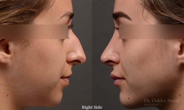 Dr. Oakley Smith accomplishes during his surgeries than a collection of before and after case studies. As one of a hand full of surgeons in North America who limits his practice to only Rhinoplasty surgery