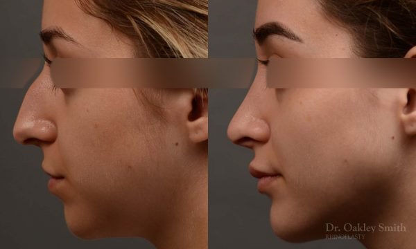 Dr. Oakley Smith accomplishes during his surgeries than a collection of before and after case studies. As one of a hand full of surgeons in North America who limits his practice to only Rhinoplasty surgery