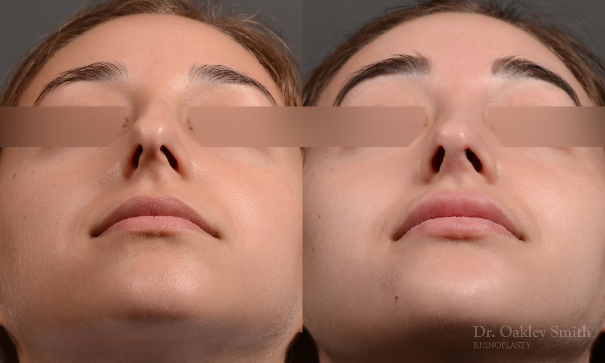 Dr. Oakley Smith accomplishes during his surgeries than a collection of before and after case studies. As one of a hand full of surgeons in North America who limits his practice to only Rhinoplasty surgery