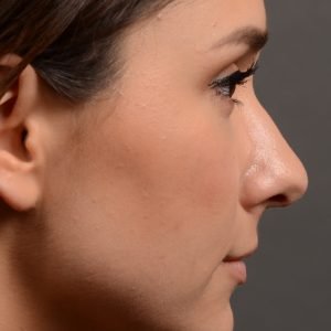 430 rhinoplasty, dr oakley smith, toronto, top surgeon, nose job