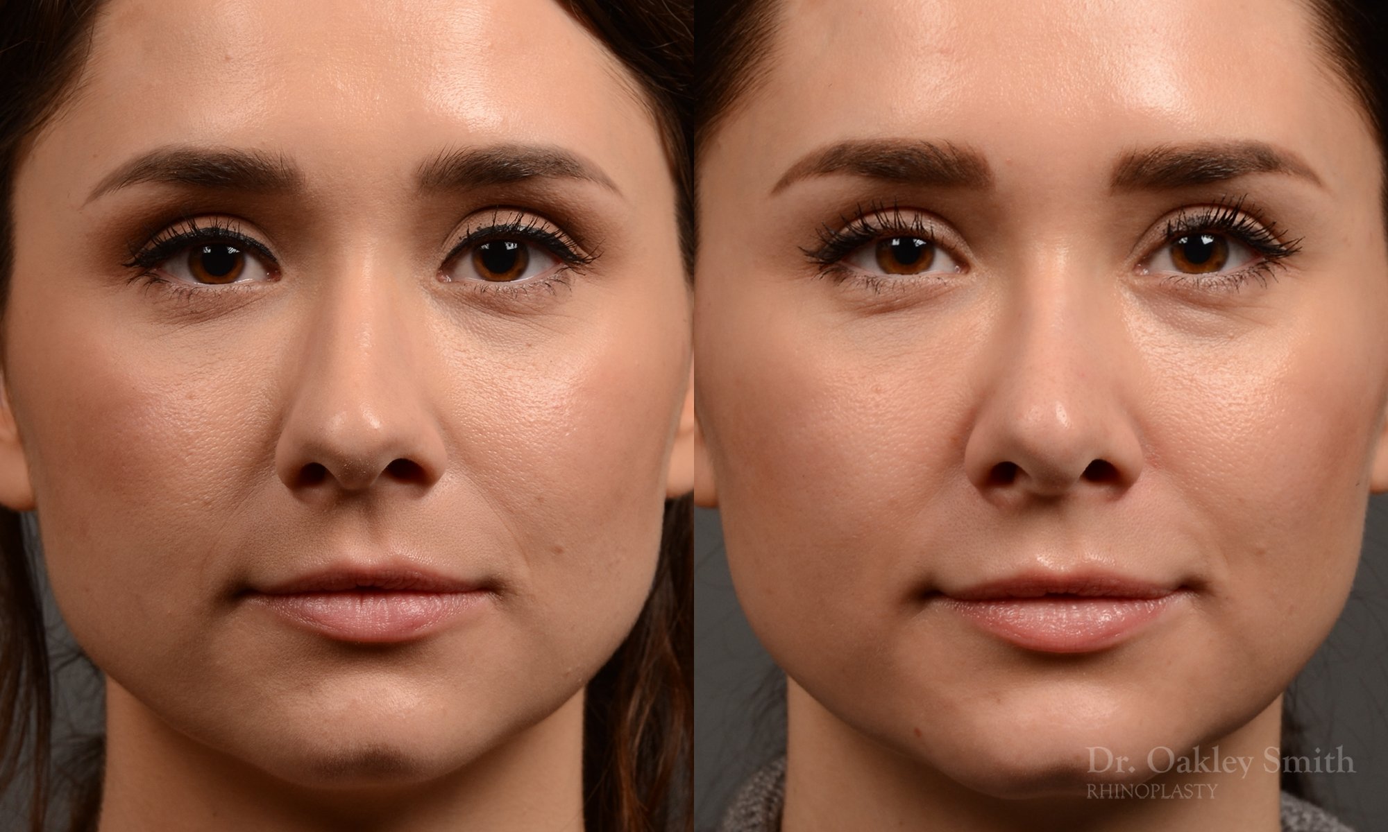 430 rhinoplasty, dr oakley smith, toronto, top surgeon, nose job