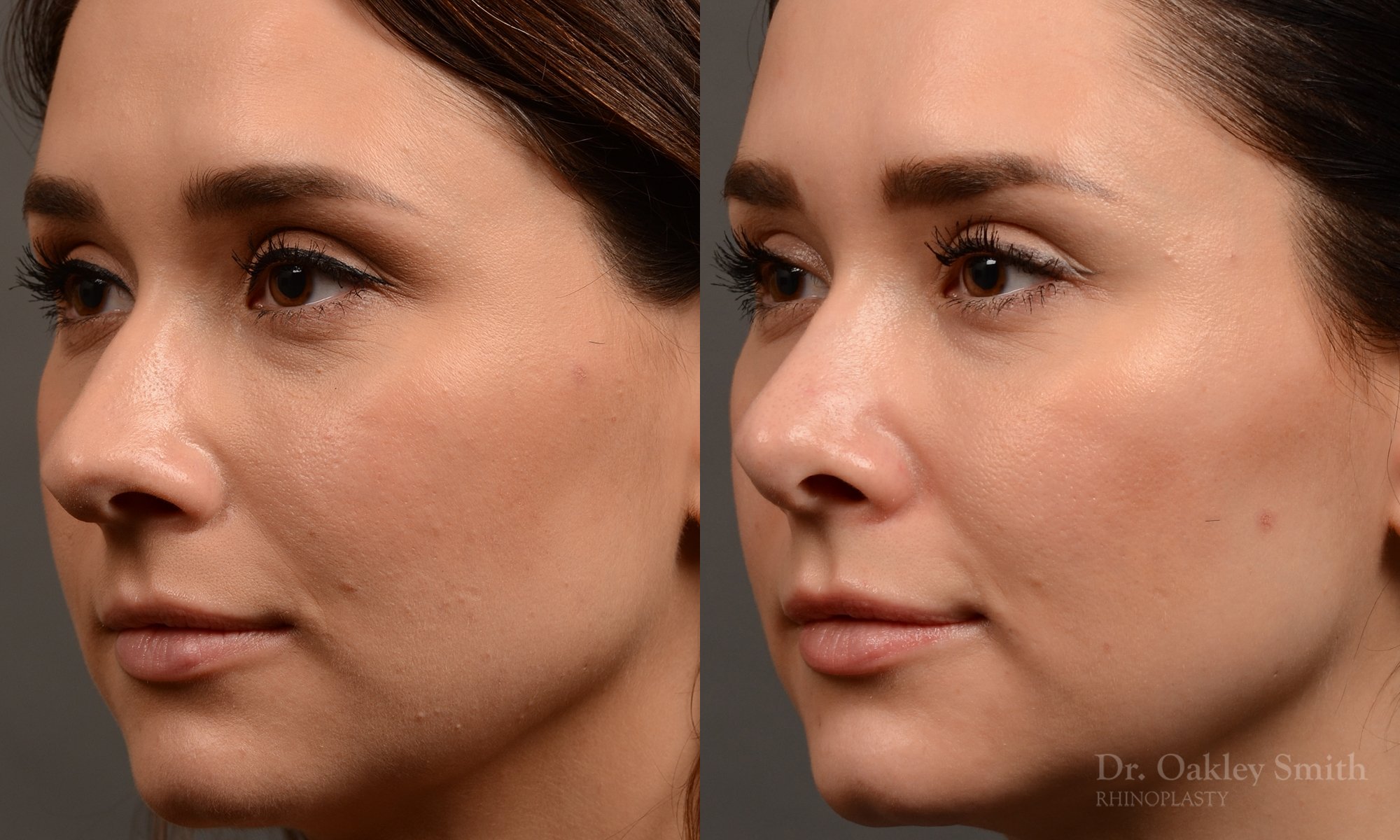 430 rhinoplasty, dr oakley smith, toronto, top surgeon, nose job