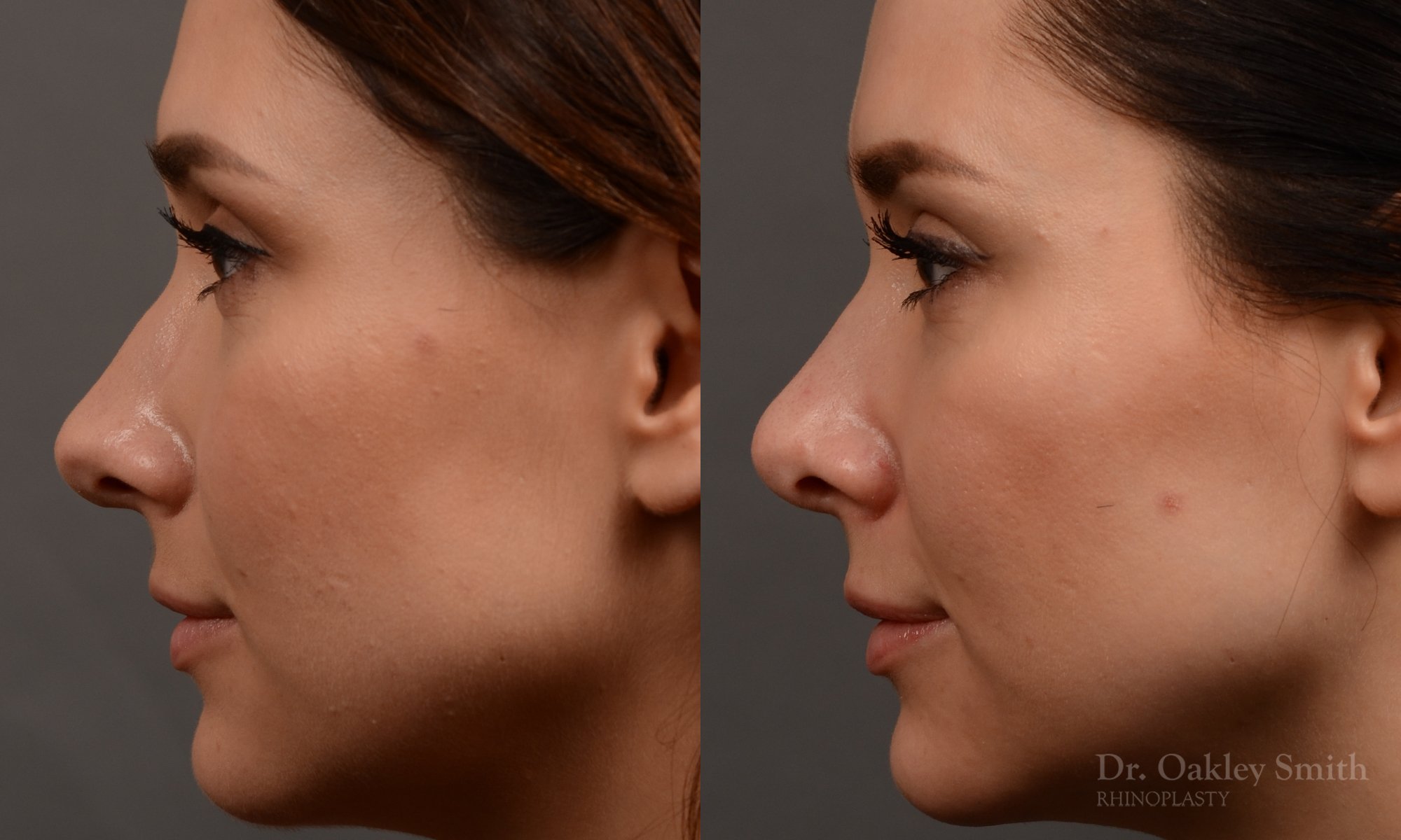 430 rhinoplasty, dr oakley smith, toronto, top surgeon, nose job