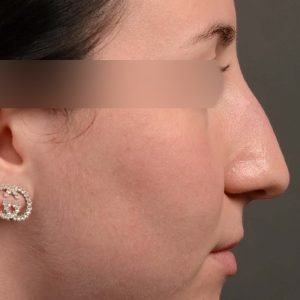432 rhinoplasty, dr oakley smith, toronto, top surgeon, nose job