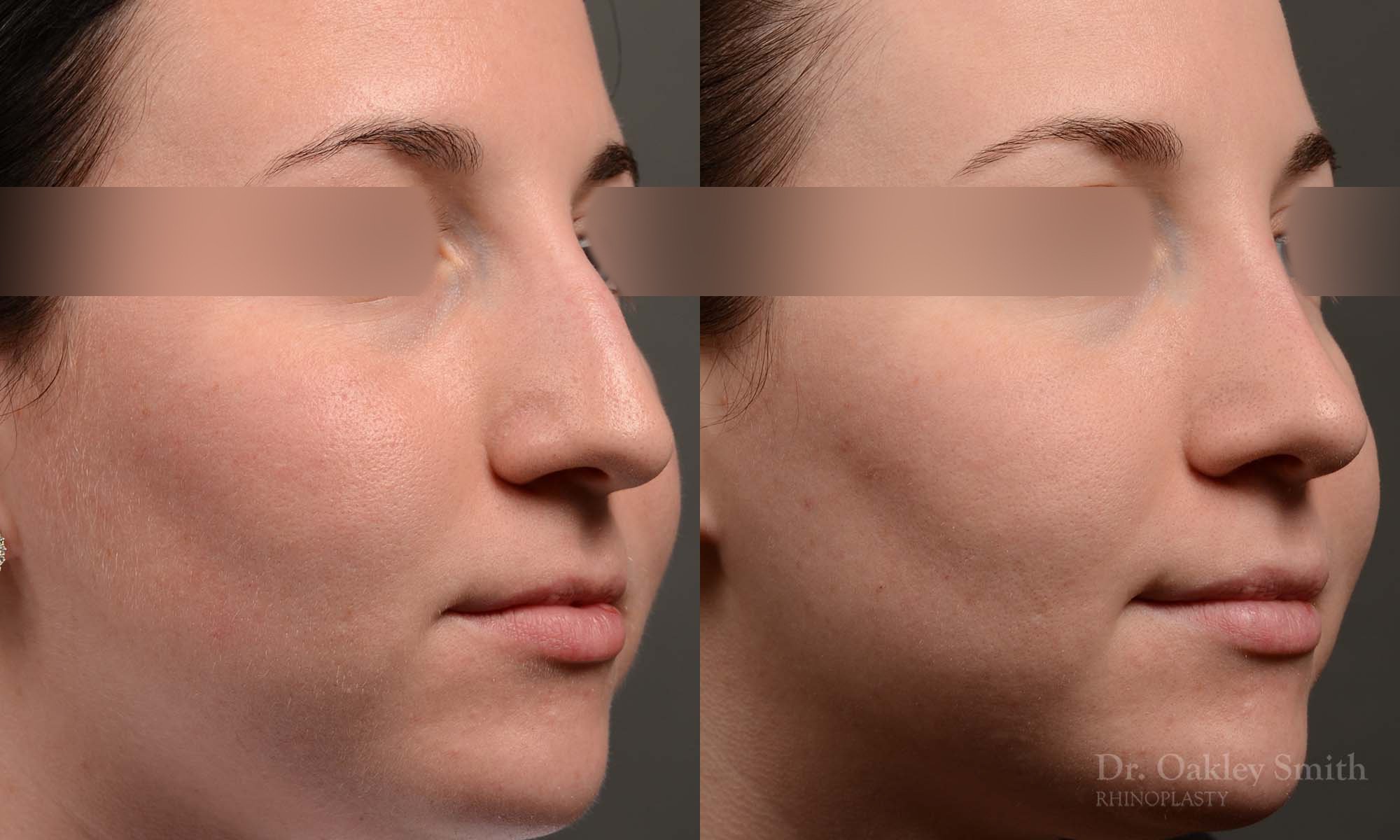 432 rhinoplasty, dr oakley smith, toronto, top surgeon, nose job