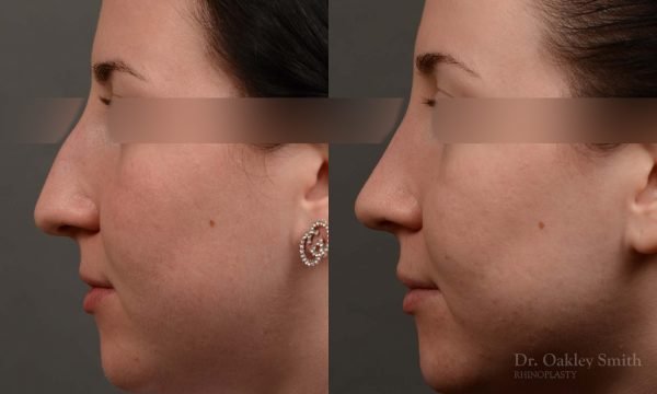 432 rhinoplasty, dr oakley smith, toronto, top surgeon, nose job