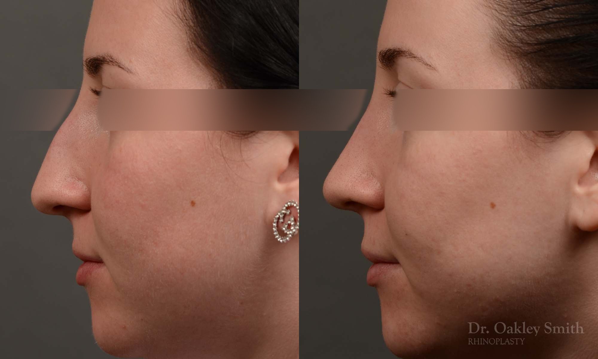 432 rhinoplasty, dr oakley smith, toronto, top surgeon, nose job