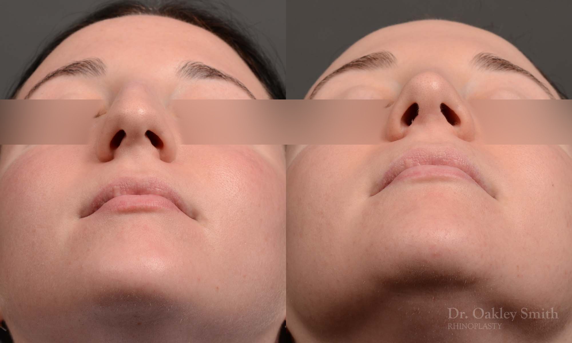 432 rhinoplasty, dr oakley smith, toronto, top surgeon, nose job