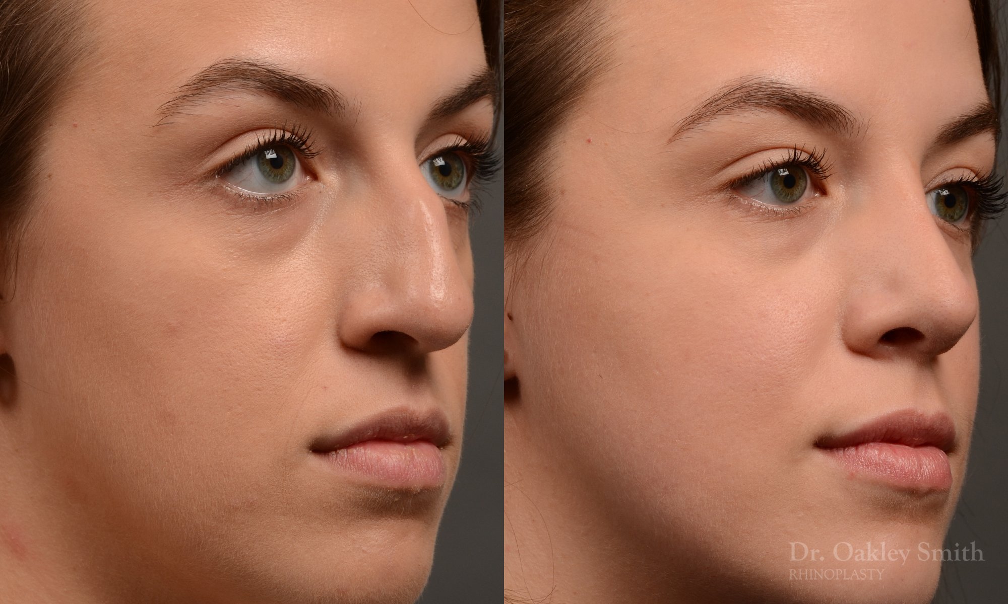 433 rhinoplasty, dr oakley smith, toronto, top surgeon, nose job